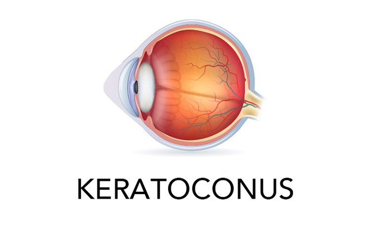 Keratoconus