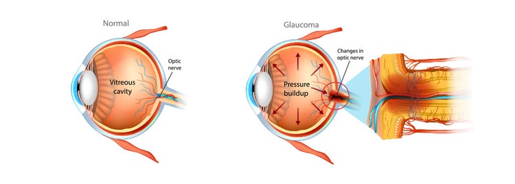 Glaucoma