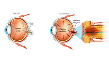 Glaucoma